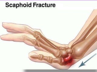 Scaphoid fracture (2)