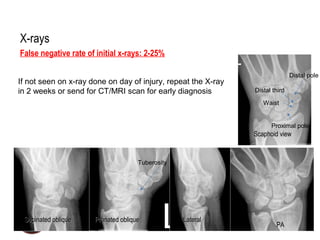 www.handsurgeryassociates.com.sg
X-rays
False negative rate of initial x-rays: 2-25%
Supinated obliqueSupinated oblique Pronated obliquePronated oblique LateralLateral
PAPA
Scaphoid viewScaphoid view
If not seen on x-ray done on day of injury, repeat the X-ray
in 2 weeks or send for CT/MRI scan for early diagnosis
Tuberosity
Distal pole
Distal third
Waist
Proximal pole
 