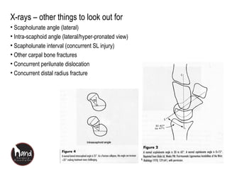 www.handsurgeryassociates.com.sg
X-rays – other things to look out for
• Scapholunate angle (lateral)
• Intra-scaphoid angle (lateral/hyper-pronated view)
• Scapholunate interval (concurrent SL injury)
• Other carpal bone fractures
• Concurrent perilunate dislocation
• Concurrent distal radius fracture
 