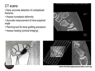 www.handsurgeryassociates.com.sg
CT scans
• Early accurate detection of undisplaced
fractures
• Assess humpback deformity
• Accurate measurement of intra-scaphoid
angle
• Planning tool for bone grafting procedure
• Assess healing (cortical bridging)
 