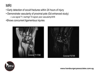 www.handsurgeryassociates.com.sg
MRI
• Early detection of occult fractures within 24 hours of injury
• Demonstrate vascularity of proximal pole (Gd enhanced study)
– Low signal T1, low/high T2 signal: poor vascularity/AVN
•Shows concurrent ligamentous injuries
Coronal FSTIRCoronal FSTIRCoronal T1 FSECoronal T1 FSE
 