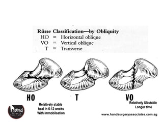 www.handsurgeryassociates.com.sg
Russe classification 1960
Relatively stableRelatively stable
heal in 6-12 weeksheal in 6-12 weeks
With immobilsationWith immobilsation
Relatively UNstableRelatively UNstable
Longer timeLonger time
 
