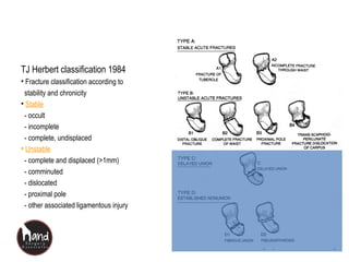 www.handsurgeryassociates.com.sg
TJ Herbert classification 1984
• Fracture classification according to
stability and chronicity
• Stable
- occult
- incomplete
- complete, undisplaced
• Unstable
- complete and displaced (>1mm)
- comminuted
- dislocated
- proximal pole
- other associated ligamentous injury
 