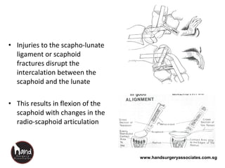 www.handsurgeryassociates.com.sg
• Injuries to the scapho-lunate
ligament or scaphoid
fractures disrupt the
intercalation between the
scaphoid and the lunate
• This results in flexion of the
scaphoid with changes in the
radio-scaphoid articulation
 