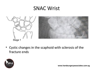 www.handsurgeryassociates.com.sg
SNAC Wrist
• Cystic changes in the scaphoid with sclerosis of the
fracture ends
Stage 1
 