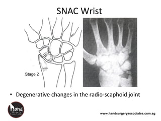 www.handsurgeryassociates.com.sg
SNAC Wrist
• Degenerative changes in the radio-scaphoid joint
Stage 2
 