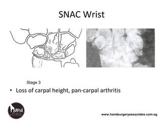 www.handsurgeryassociates.com.sg
SNAC Wrist
• Loss of carpal height, pan-carpal arthritis
Stage 3
 