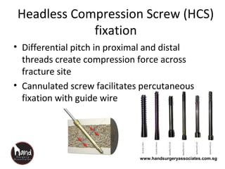 www.handsurgeryassociates.com.sg
Headless Compression Screw (HCS)
fixation
• Differential pitch in proximal and distal
threads create compression force across
fracture site
• Cannulated screw facilitates percutaneous
fixation with guide wire
 