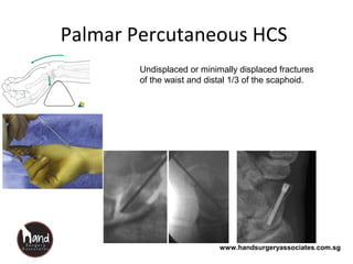 www.handsurgeryassociates.com.sg
Palmar Percutaneous HCS
Undisplaced or minimally displaced fractures
of the waist and distal 1/3 of the scaphoid.
 