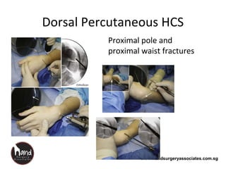 www.handsurgeryassociates.com.sg
Dorsal Percutaneous HCS
Proximal pole and
proximal waist fractures
 