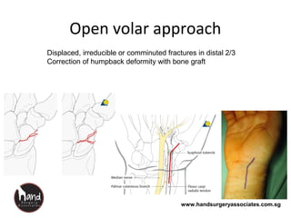 www.handsurgeryassociates.com.sg
Open volar approach
Displaced, irreducible or comminuted fractures in distal 2/3
Correction of humpback deformity with bone graft
 