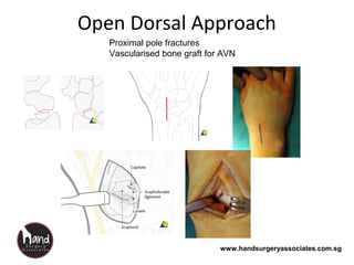 www.handsurgeryassociates.com.sg
Open Dorsal Approach
Proximal pole fractures
Vascularised bone graft for AVN
 