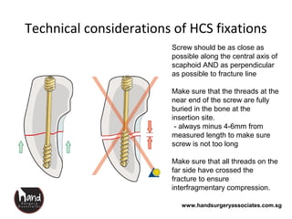 www.handsurgeryassociates.com.sg
Technical considerations of HCS fixations
Screw should be as close as
possible along the central axis of
scaphoid AND as perpendicular
as possible to fracture line
Make sure that the threads at the
near end of the screw are fully
buried in the bone at the
insertion site.
- always minus 4-6mm from
measured length to make sure
screw is not too long
Make sure that all threads on the
far side have crossed the
fracture to ensure
interfragmentary compression.
 