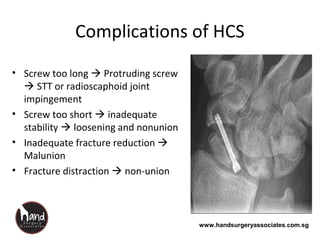 www.handsurgeryassociates.com.sg
Complications of HCS
• Screw too long  Protruding screw
 STT or radioscaphoid joint
impingement
• Screw too short  inadequate
stability  loosening and nonunion
• Inadequate fracture reduction 
Malunion
• Fracture distraction  non-union
 
