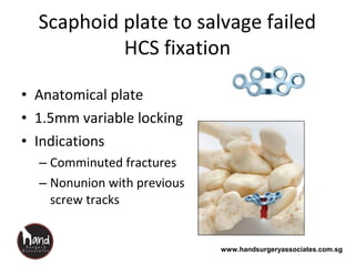 www.handsurgeryassociates.com.sg
Scaphoid plate to salvage failed
HCS fixation
• Anatomical plate
• 1.5mm variable locking
• Indications
– Comminuted fractures
– Nonunion with previous
screw tracks
 