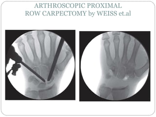 ARTHROSCOPIC PROXIMAL
ROW CARPECTOMY by WEISS et.al
 