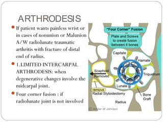 ARTHRODESIS
If patient wants painless wrist or
in cases of nonunion or Malunion
A/W radiolunate traumatic
arthritis with fracture of distal
end of radius.
1.LIMITED INTERCARPAL
ARTHRODESIS: when
degenerative changes involve the
midcarpal joint.
Four corner fusion : if
radiolunate joint is not involved
 