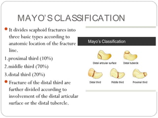 MAYO’SCLASSIFICATION
It divides scaphoid fractures into
three basic types according to
anatomic location of the fracture
line.
1.proximal third (10%)
2.middle third (70%)
3.distal third (20%)
Fracture of the distal third are
further divided according to
involvement of the distal articular
surface or the distal tubercle.
 