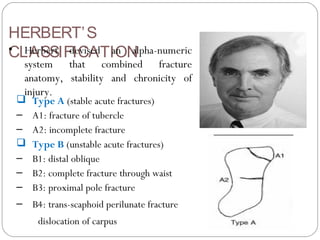 HERBERT’S
CLASSIFICATION• Herbert devised an alpha-numeric
system that combined fracture
anatomy, stability and chronicity of
injury.
 Type A (stable acute fractures)
– A1: fracture of tubercle
– A2: incomplete fracture
 Type B (unstable acute fractures)
– B1: distal oblique
– B2: complete fracture through waist
– B3: proximal pole fracture
– B4: trans-scaphoid perilunate fracture
dislocation of carpus
 