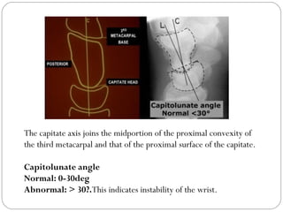 The capitate axis joins the midportion of the proximal convexity of
the third metacarpal and that of the proximal surface of the capitate.
Capitolunate angle
Normal: 0-30deg
Abnormal: > 30?.This indicates instability of the wrist.
 
