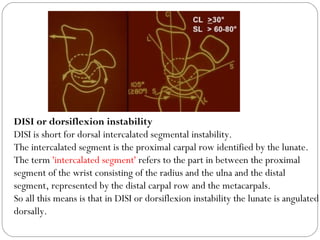 DISI or dorsiflexion instability
DISI is short for dorsal intercalated segmental instability. 
The intercalated segment is the proximal carpal row identified by the lunate.
The term 'intercalated segment' refers to the part in between the proximal
segment of the wrist consisting of the radius and the ulna and the distal
segment, represented by the distal carpal row and the metacarpals. 
So all this means is that in DISI or dorsiflexion instability the lunate is angulated
dorsally. 
 