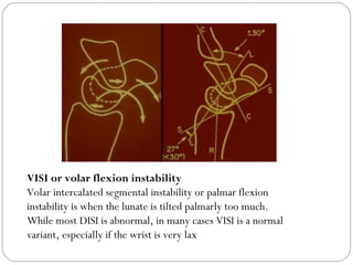 VISI or volar flexion instability
Volar intercalated segmental instability or palmar flexion
instability is when the lunate is tilted palmarly too much. 
While most DISI is abnormal, in many cases VISI is a normal
variant, especially if the wrist is very lax
 