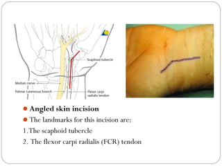 Angled skin incision
The landmarks for this incision are:
1.The scaphoid tubercle
2. The flexor carpi radialis (FCR) tendon
 