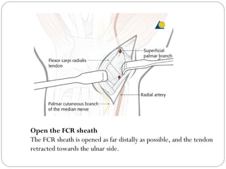 Open the FCR sheath
The FCR sheath is opened as far distally as possible, and the tendon
retracted towards the ulnar side.
 