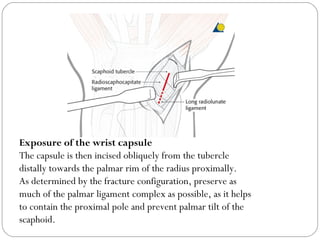 Exposure of the wrist capsule
The capsule is then incised obliquely from the tubercle
distally towards the palmar rim of the radius proximally.
As determined by the fracture configuration, preserve as
much of the palmar ligament complex as possible, as it helps
to contain the proximal pole and prevent palmar tilt of the
scaphoid.
 