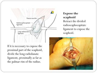 Expose the
scaphoid
Retract the divided
radioscaphocapitate
ligament to expose the
scaphoid.
If it is necessary to expose the
proximal part of the scaphoid,
divide the long radiolunate
ligament, proximally as far as
the palmar rim of the radius.
 