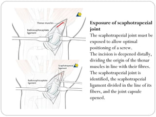 Exposure of scaphotrapezial
joint
The scaphotrapezial joint must be
exposed to allow optimal
positioning of a screw.
The incision is deepened distally,
dividing the origin of the thenar
muscles in line with their fibres.
The scaphotrapezial joint is
identified, the scaphotrapezial
ligament divided in the line of its
fibers, and the joint capsule
opened.
 