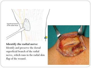 Identify the radial nerve
Identify and preserve the dorsal
superficial branch of the radial
nerve, which runs in the radial skin
flap of the wound.
 