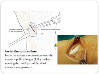 Incise the retinaculum
Incise the extensor retinaculum over the
extensor pollicis longus (EPL) tendon
opening the distal part of the third
extensor compartment.
 