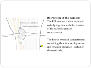 Retraction of the tendons
The EPL tendon is then retracted
radially together with the tendons
of the second extensor
compartment.
The fourth extensor compartment,
containing the extensor digitorum
and extensor indicis, is located on
the ulnar side.
 
