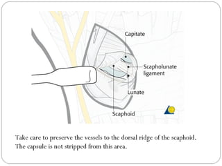 Take care to preserve the vessels to the dorsal ridge of the scaphoid.
The capsule is not stripped from this area.
 