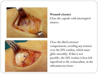 Wound closure
Close the capsule with interrupted
sutures.
Close the third extensor
compartment, avoiding any tension
over the EPL tendon, which must
glide smoothly. If this is not
possible, the EPL tendon is best left
superficial to the retinaculum, in the
subcutaneous tissue.
 