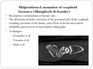 Malpositioned nonunion of scaphoid
fractures (Humpback deformity)
• Resorption/communition at fracture site.
• The deformity includes extension of the proximal pole of the scaphoid,
resulting extension of the lunate, and a form of dorsal intercalated
instability pattern seen on lateral plain radiographs
• Techniques-
– Fernandez et al
– Tomaino et al
– Stark et al
 