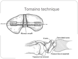 Tomaino technique
 