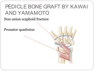PEDICLE BONE GRAFT BY KAWAI
AND YAMAMOTO
Non union scaphoid fracture
Pronator quadratus
 