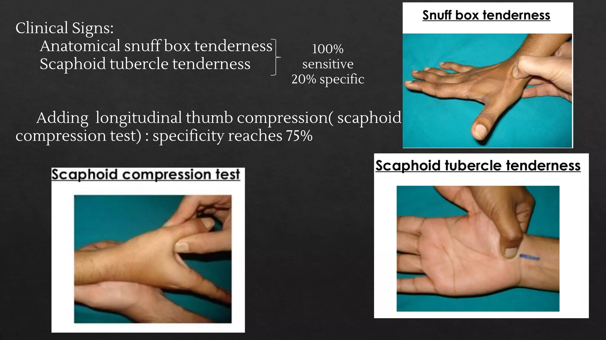 Scaphoid Test Scaphoid fracture and perilunate dislocation | PDF
