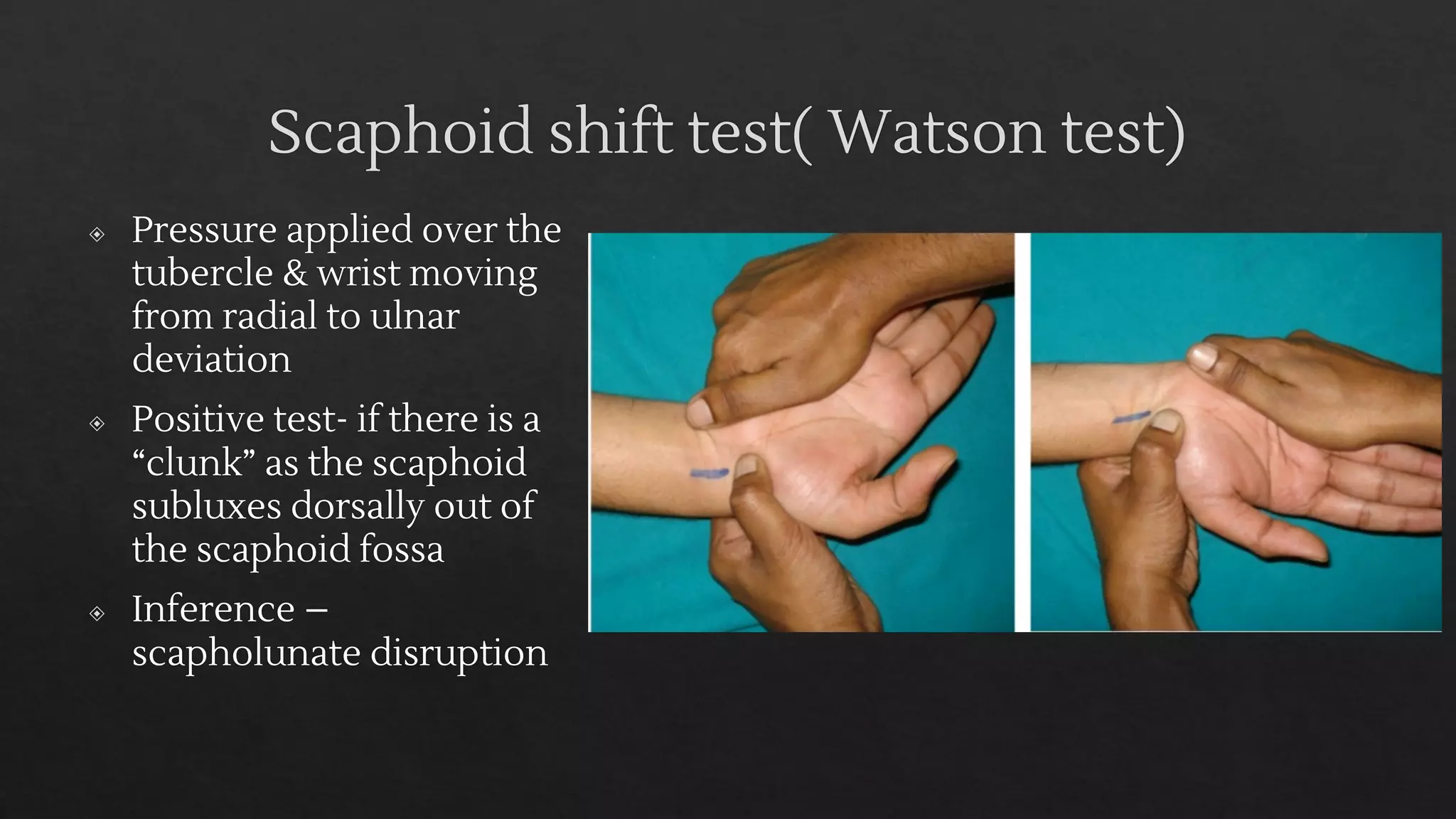 scaphoid-fracture-and-perilunate-dislocation-ppt