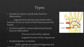 Scaphoid fracture and perilunate dislocation | PDF