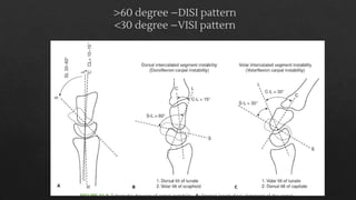 Scaphoid fracture and perilunate dislocation | PDF