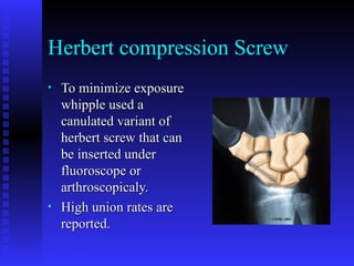 Comprehensive Overview of Scaphoid Fractures: Anatomy, Diagnosis, and ...