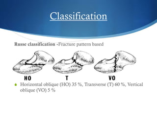 Classification
Russe classification -Fracture pattern based

S Horizontal oblique (HO) 35 %, Transverse (T) 60 %, Vertical

oblique (VO) 5 %

 
