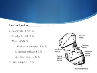 Based on location

a. Tuberosity : 17-20 %
b. Distal pole : 10-12 %
c. Waist : 66-70 %
i. Horisontal oblique: 13-14 %

ii. Vertical oblique: 8-9 %
iii. Transverse: 45-48 %
d. Proximal pole 5-7 %

 
