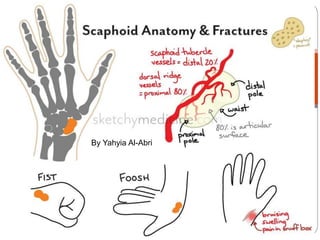 Yahyia alabri
Junior
Scaphoid fractures
By Yahyia Al-Abri
 