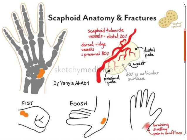 scaphoid fracture