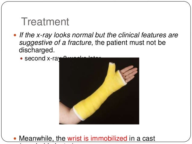 scaphoid fracture