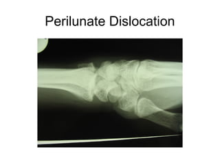 Perilunate Dislocation
 